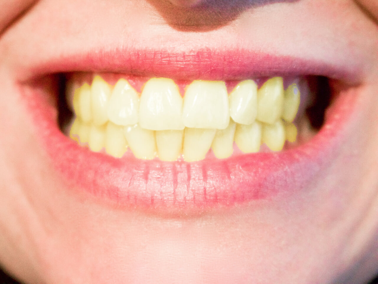 women-yellow-teeth